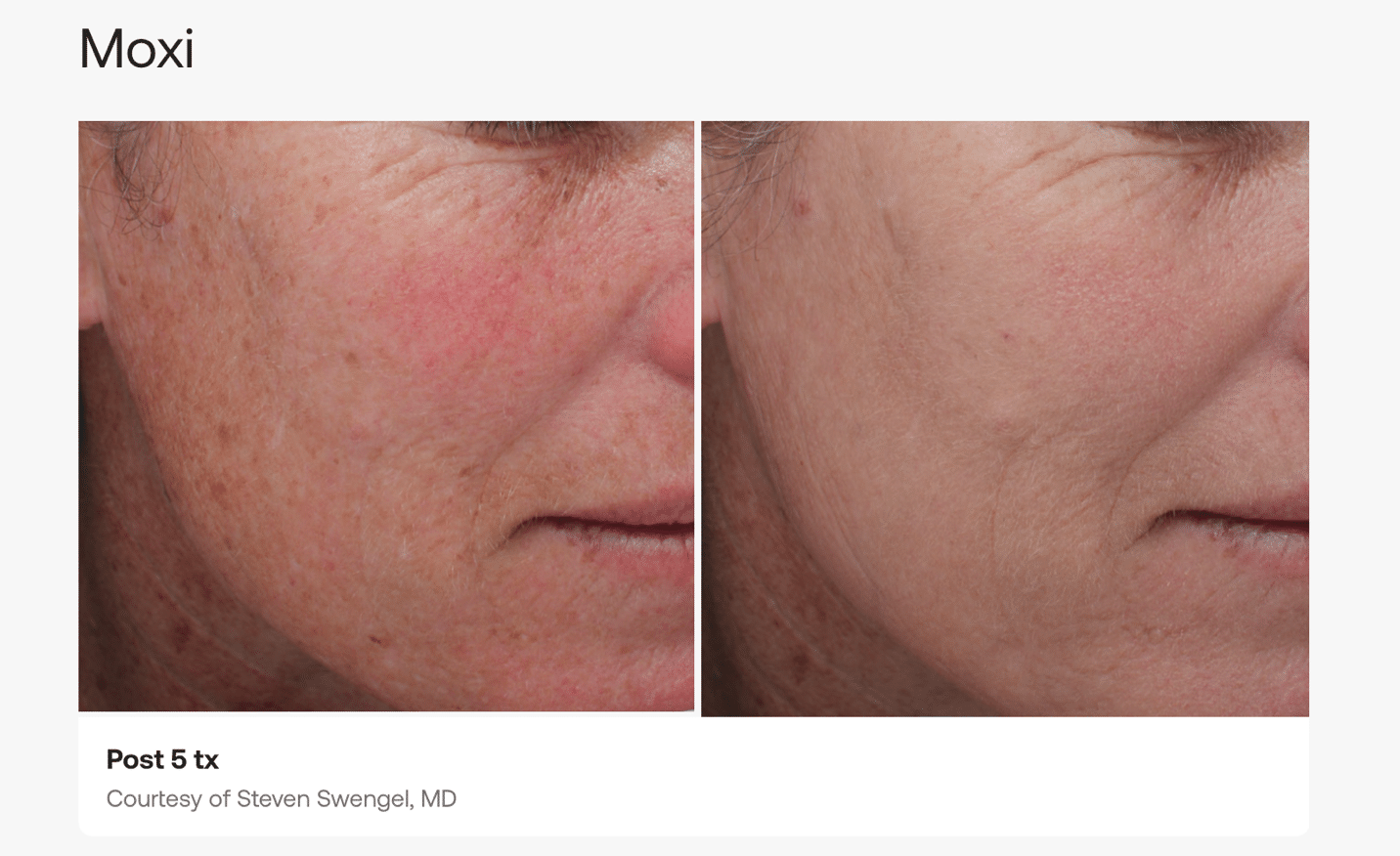 Before and After Image: Moxi - front