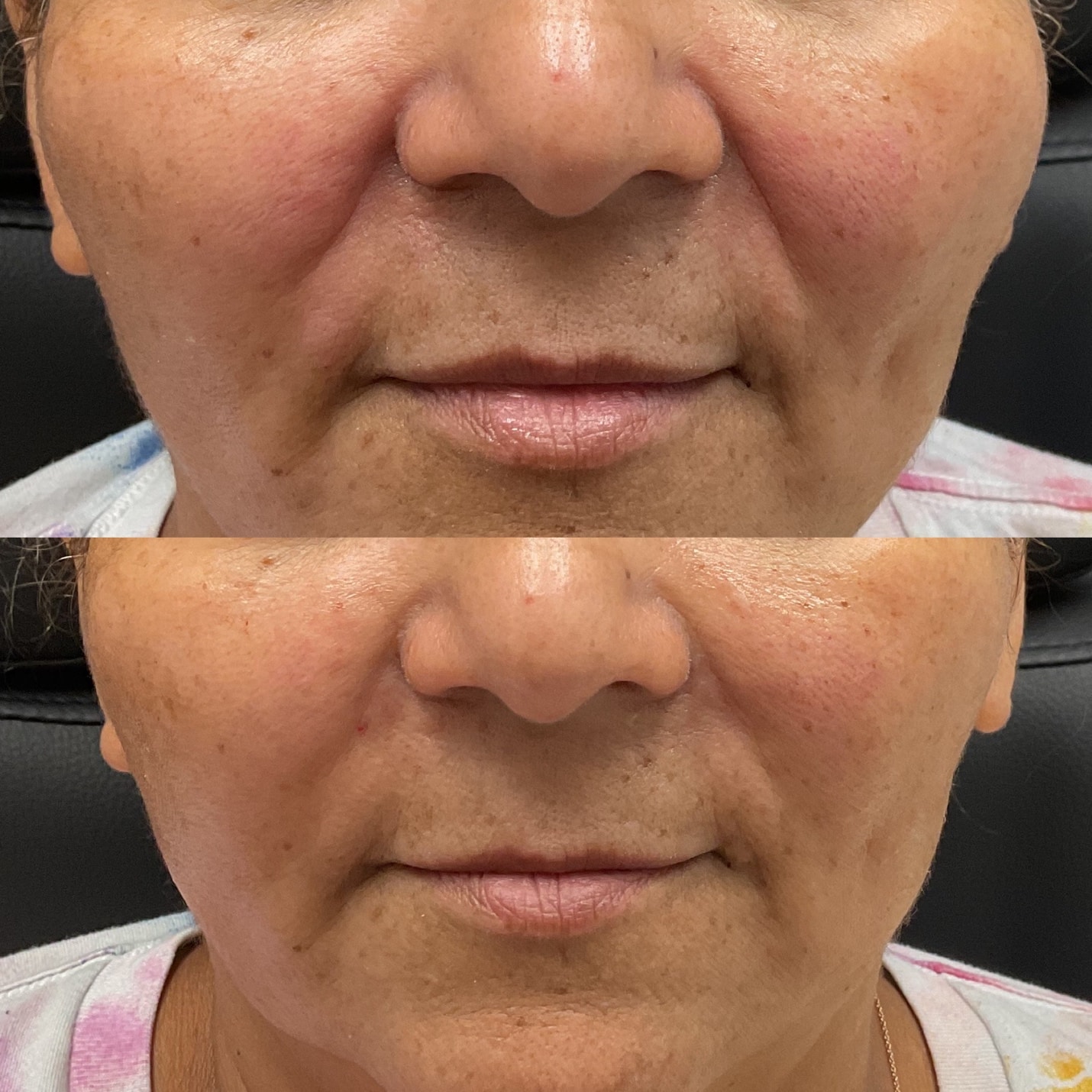 Before and After Image: Smile Line Filler - front