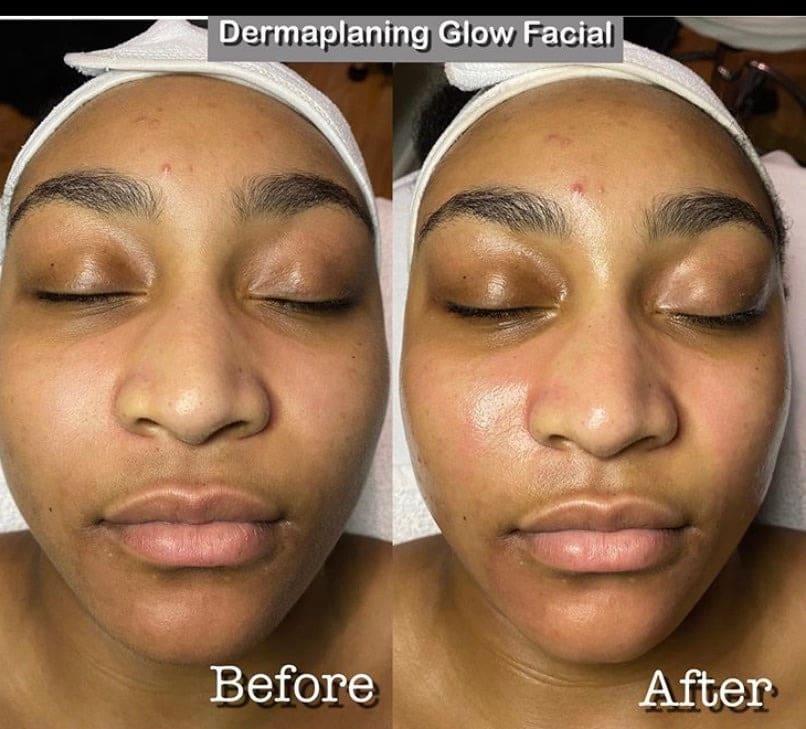 Dermaplaning 2 image 12