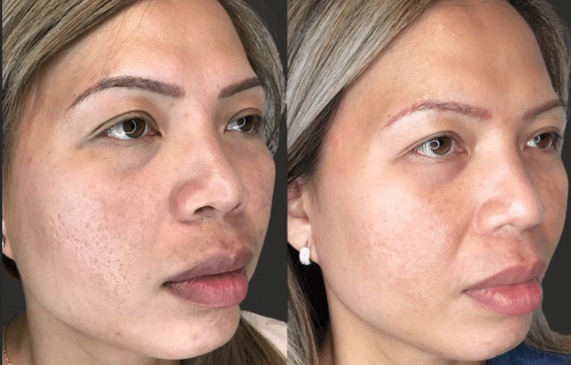Microneedling 2 image 4