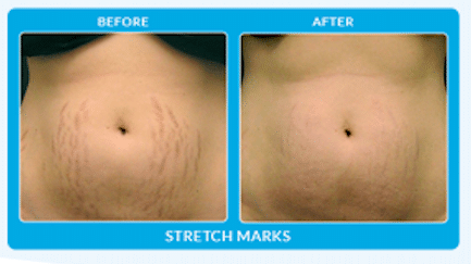 Microneedling 3 image 5