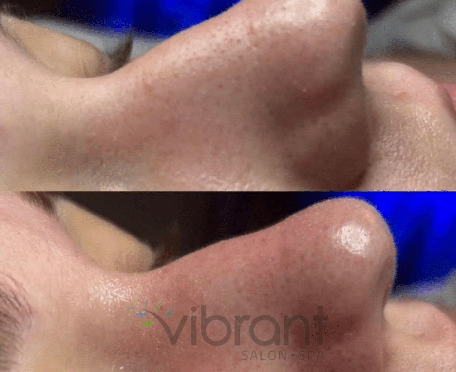 HydraFacial 7 image 10