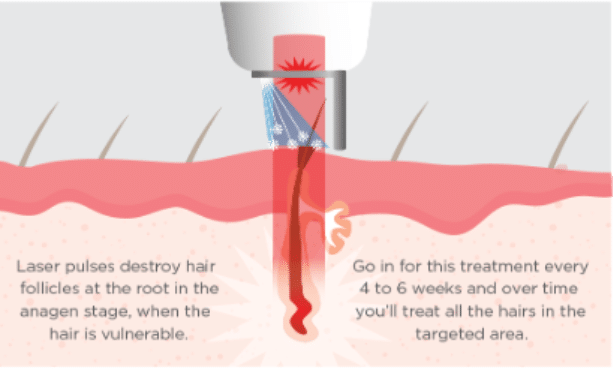Laser Hair Removal 4 image 33