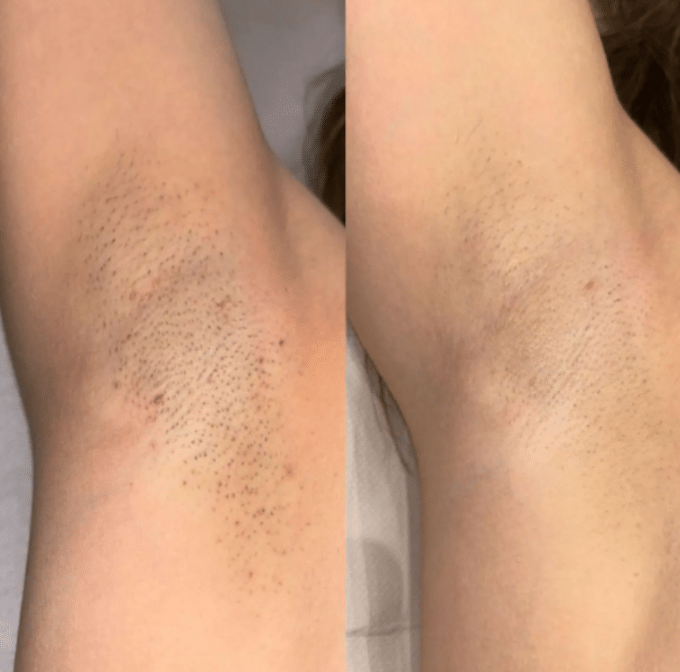 Laser Hair Removal 5 image 36