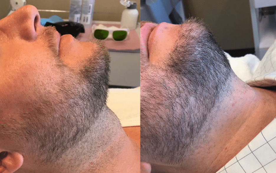 Laser Hair Removal 6 image 37