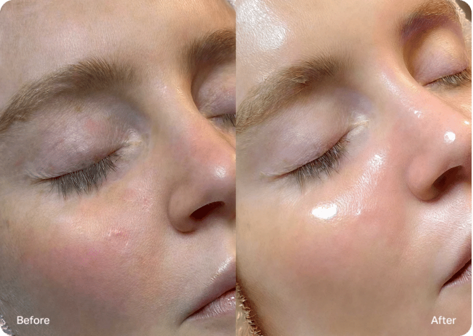 HydraFacial 2 image 5