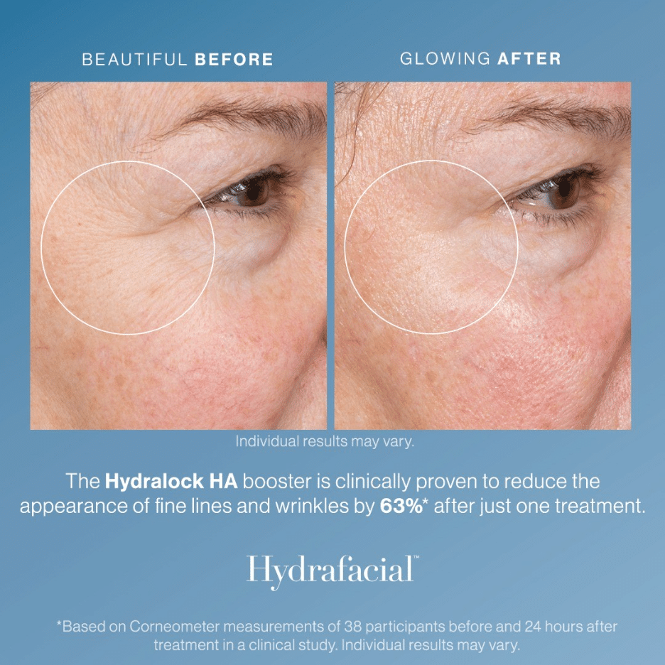 HydraFacial 4 image 6